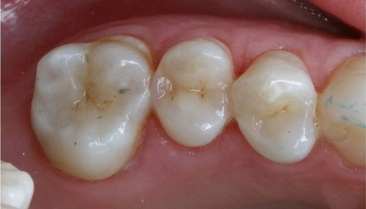 بعد العلاج — حشوة تجميلية متطابقة